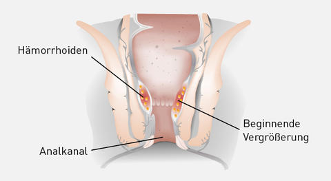 Graphische Darstellung Hämorrhoiden 1. Grades