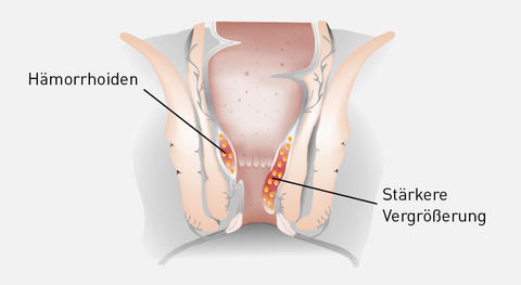 Graphische Darstellung Hämorrhoiden 2. Grades