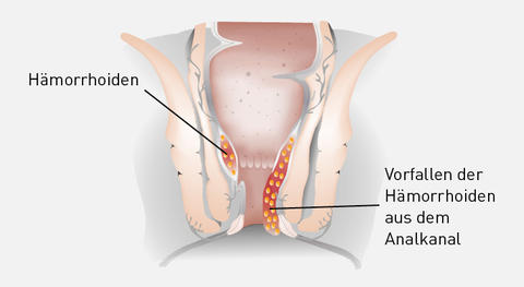 Graphische Darstellung Hämorrhoiden 3. Grades