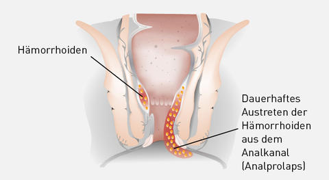 Graphische Darstellung Hämorrhoiden 4. Grades